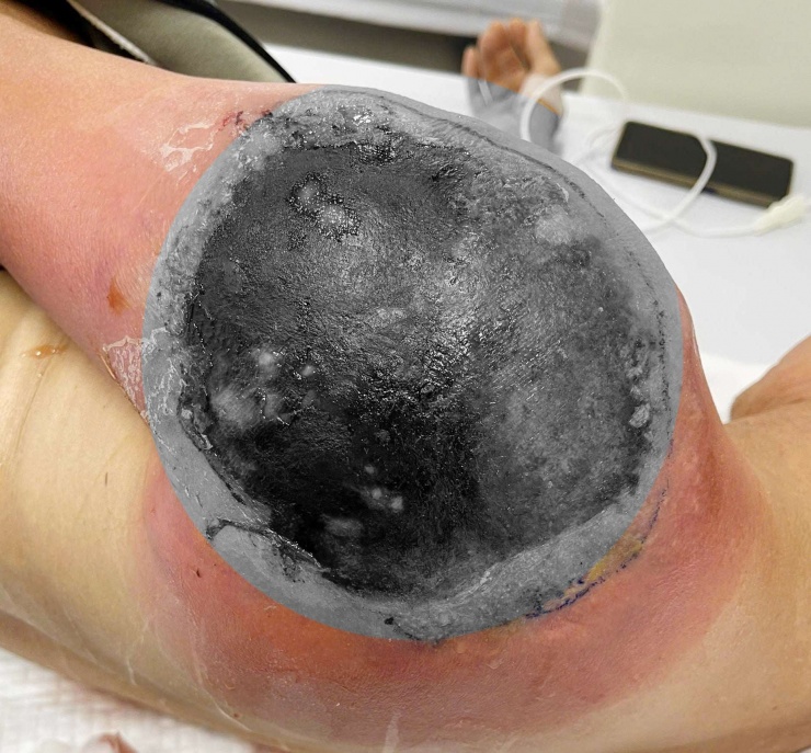 Vết thương sưng đỏ của bệnh nhân khi nhập viện. Ảnh BVCC