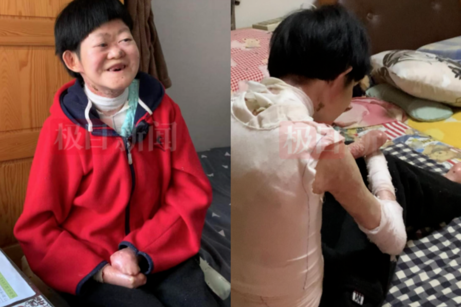 Từng bị chẩn đoán không sống quá 2 tuổi, “cô gái bươm bướm” hiện tại ra sao ở tuổi 25?- Ảnh 1.