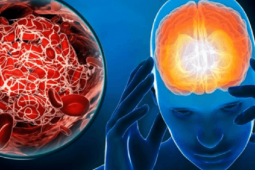 Đột quỵ não giai đoạn sớm không phải đau đầu, mà là 4 dấu hiệu này