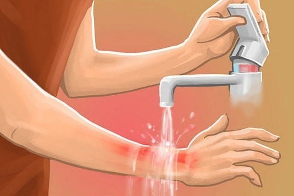 Vào bếp ngày Tết, bị bỏng nhiệt, đứt tay xử lý thế nào? - 1