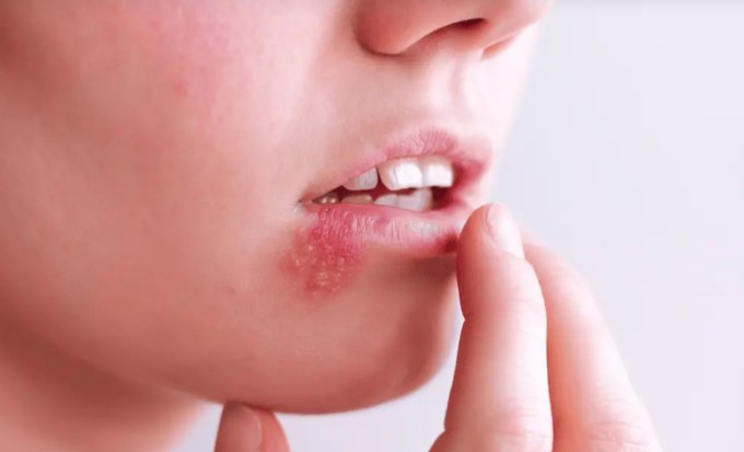 Người phụ nữ 30 tuổi chết não vì chủ quan với mụn rộp khóe miệng 1 Ảnh minh họa: Thomson Medical