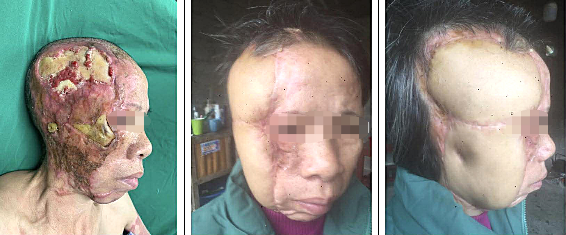 Bác sĩ kéo những 'đường mạch' hồi sinh cuộc đời người di chứng bỏng 3 vi phẫu - Ảnh 4.