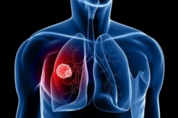 Phát hiện mắc 2 bệnh ung thư từ triệu chứng đau bụng