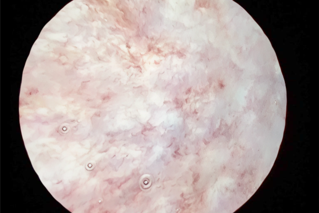 Bơm chất nhờn - giải pháp phục hồi niêm mạc bàng quang viêm tái diễn - 2