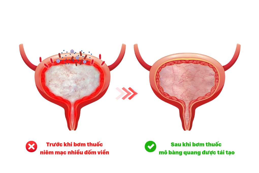 Bơm chất nhờn - giải pháp phục hồi niêm mạc bàng quang viêm tái diễn - 4