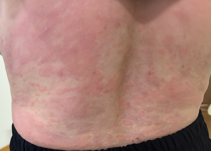 Bác sĩ Tân kiểm tra tình trạng da của bà Minh sau điều trị. Ảnh: Bệnh viện Đa khoa Tâm Anh