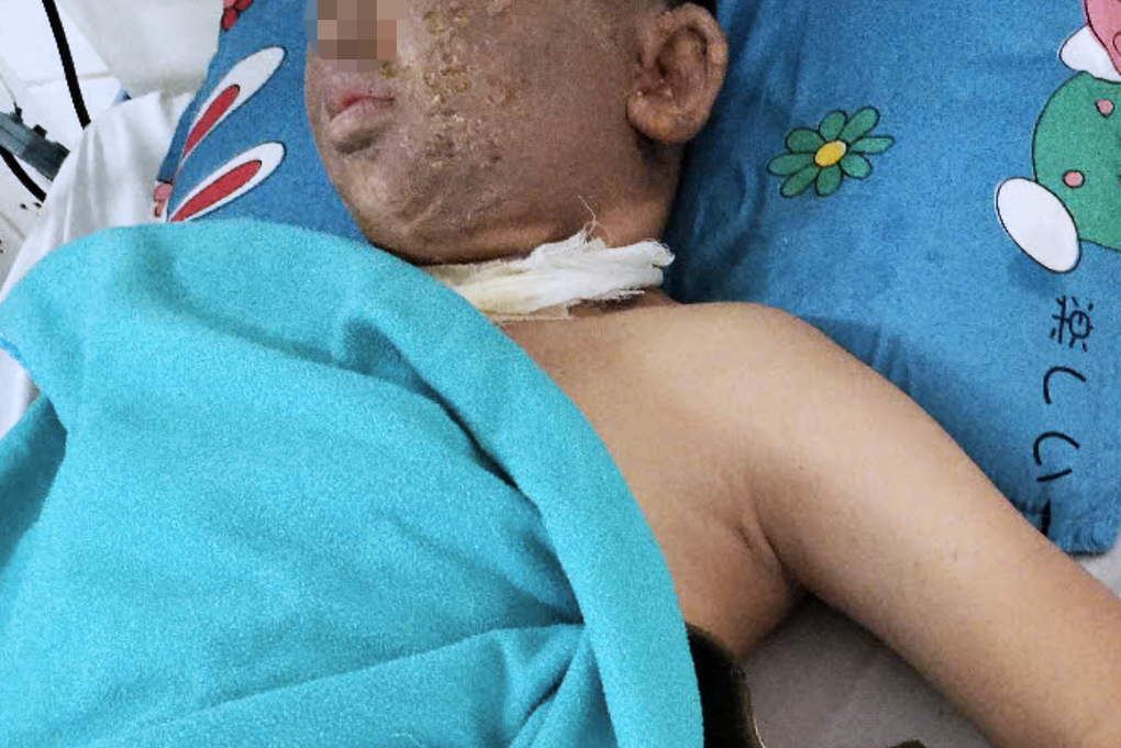 Biến dạng mặt, cắt bỏ nhãn cầu vì pháo nổ: Cảnh báo các loại pháo lạ - 3