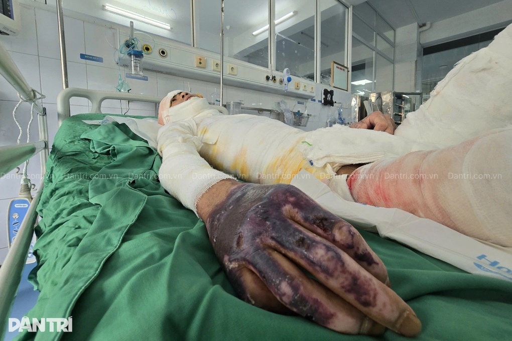 Vợ bán nương, khẩn cầu cứu chồng bỏng 66% cơ thể, có 95% cơ hội sống - 2