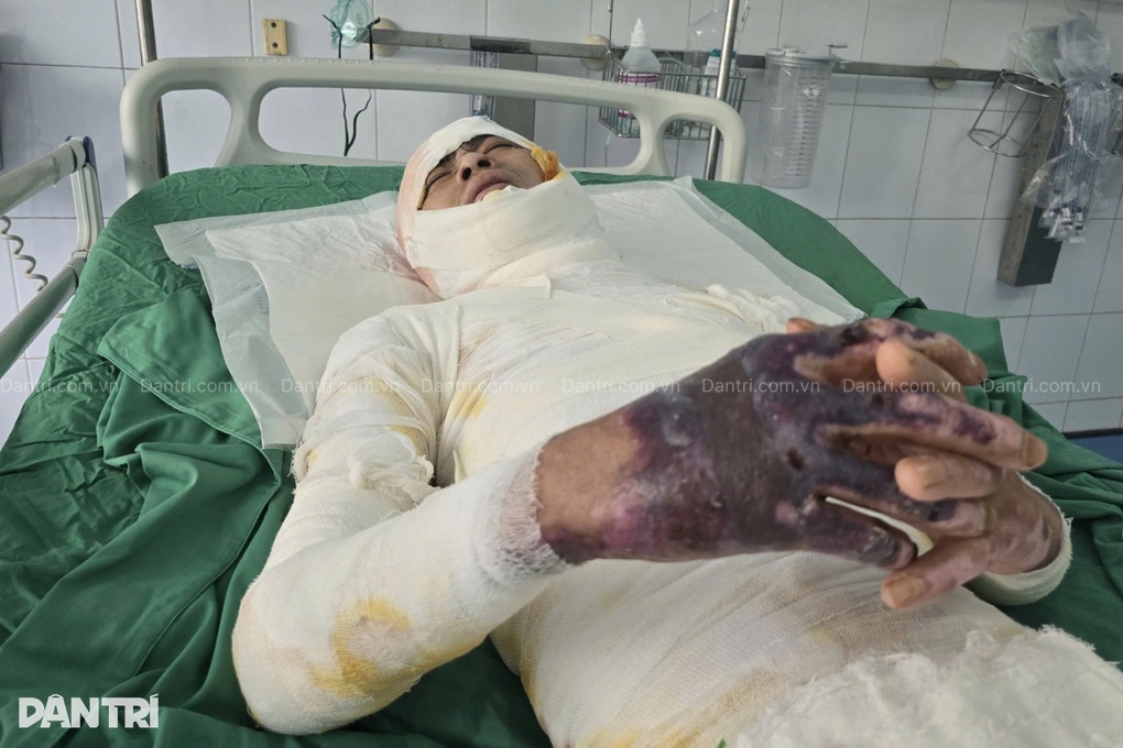 Vợ bán nương, khẩn cầu cứu chồng bỏng 66% cơ thể, có 95% cơ hội sống - 3