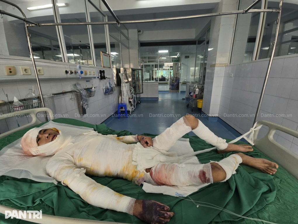 Vợ bán nương, khẩn cầu cứu chồng bỏng 66% cơ thể, có 95% cơ hội sống - 5