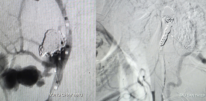 Hình ảnh ổ giả phình động mạch cảnh trong phải đoạn cổ bệnh nhân trước và sau can thiệp. Ảnh: Thanh Phong
