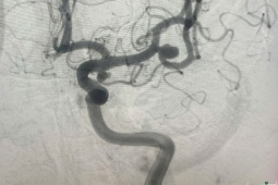 Đau đầu âm ỉ suốt 2 tuần, đi khám, người đàn ông phát hiện bệnh nguy hiểm