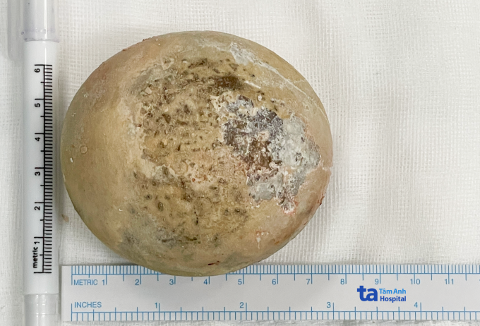 Khối sỏi to bằng nắm tay được lấy ra khỏi bàng quang người bệnh. Ảnh: Bệnh viện Đa khoa Tâm Anh