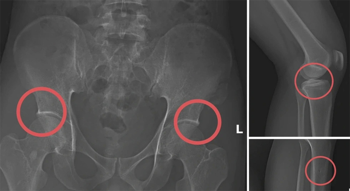 Thực nghiệm điều tra vụ tự đục vỡ xương trục lợi 6 tỷ đồng bảo hiểm- Ảnh 3.