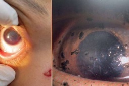 Báo động: Nhiều ca chấn thương nặng, mất thị lực vĩnh viễn do nổ pháo dịp Tết