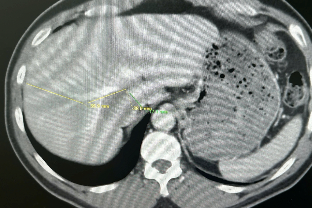 Bụng đột ngột nhô to, bé sơ sinh phát hiện khối u quái 1,3kg cực hiếm gặp - 3