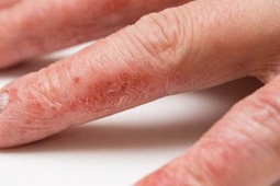 Làm cách nào để khắc phục da tay khô nứt nẻ vào mùa đông?