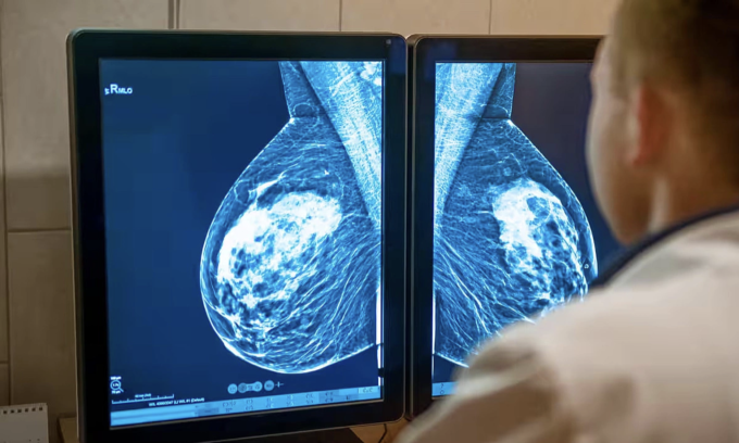 Ung thư vú nếu phát hiện ở giai đoạn sớm, quá trình điều trị thường rất nhẹ nhàng, chi phí thấp và phần lớn được bảo hiểm y tế chi trả. Ảnh: Alamy