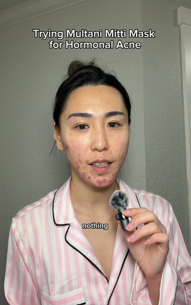 Bị đuổi việc, cô gái 27 tuổi để mặt mộc với mảng mụn lớn lên mạng tâm sự và cái kết bất ngờ- Ảnh 3. Bị đuổi việc, cô gái 27 tuổi để mặt mộc với mảng mụn lớn lên mạng tâm sự và cái kết bất ngờ- Ảnh 3.