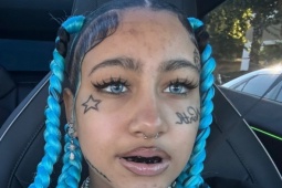 Bác sĩ cảnh báo mốt 'răng đen' của con gái Kim Kardashian