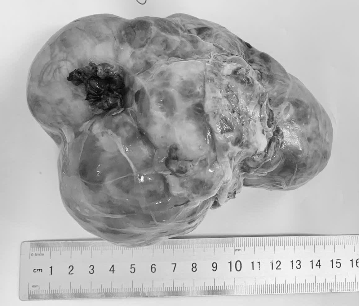 Liên tiếp trẻ mổ u ổ bụng, dấu hiệu ban đầu dễ nhầm với vấn đề tiêu hóa - Ảnh 2.