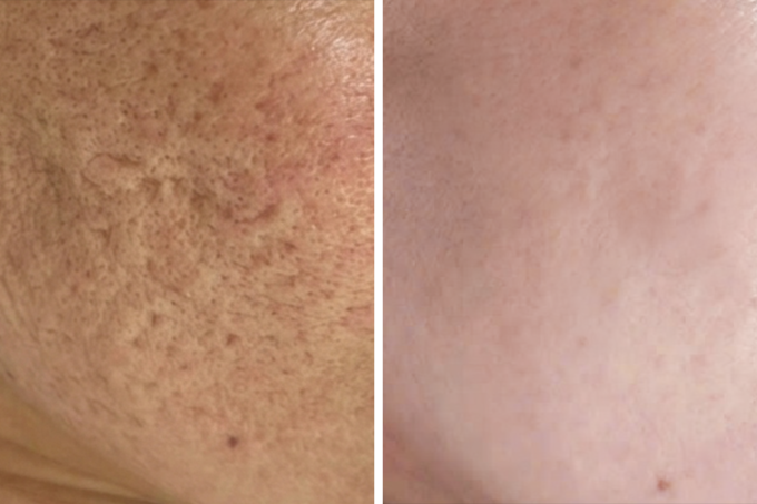 Các sẹo rỗ của chị Bình đã cải thiện đáng kể sau 4 lần tách đáy sẹo kết hợp vi kim RF. Ảnh: Bệnh viện Đa khoa Tâm Anh