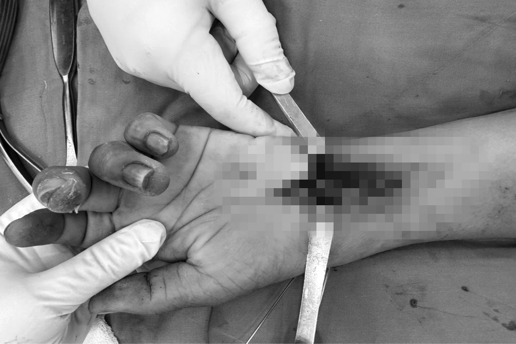 Ngã xe chống tay theo phản xạ, nhiều người phải mổ cổ tay - 2