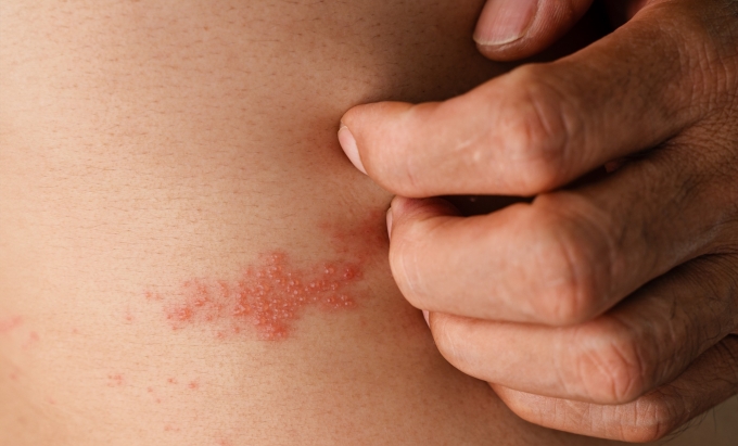 Nhiều nghiên cứu cho thấy, phụ nữ có tỷ lệ mắc zona thần kinh cao hơn. Ảnh: Vecteezy