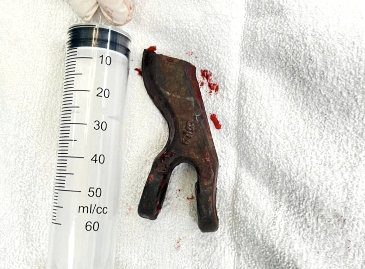 Kéo xe qua vũng lầy, tài xế bị dây xích đứt bắn thẳng vào mặt, xuyên qua hốc mắt - Ảnh 2.