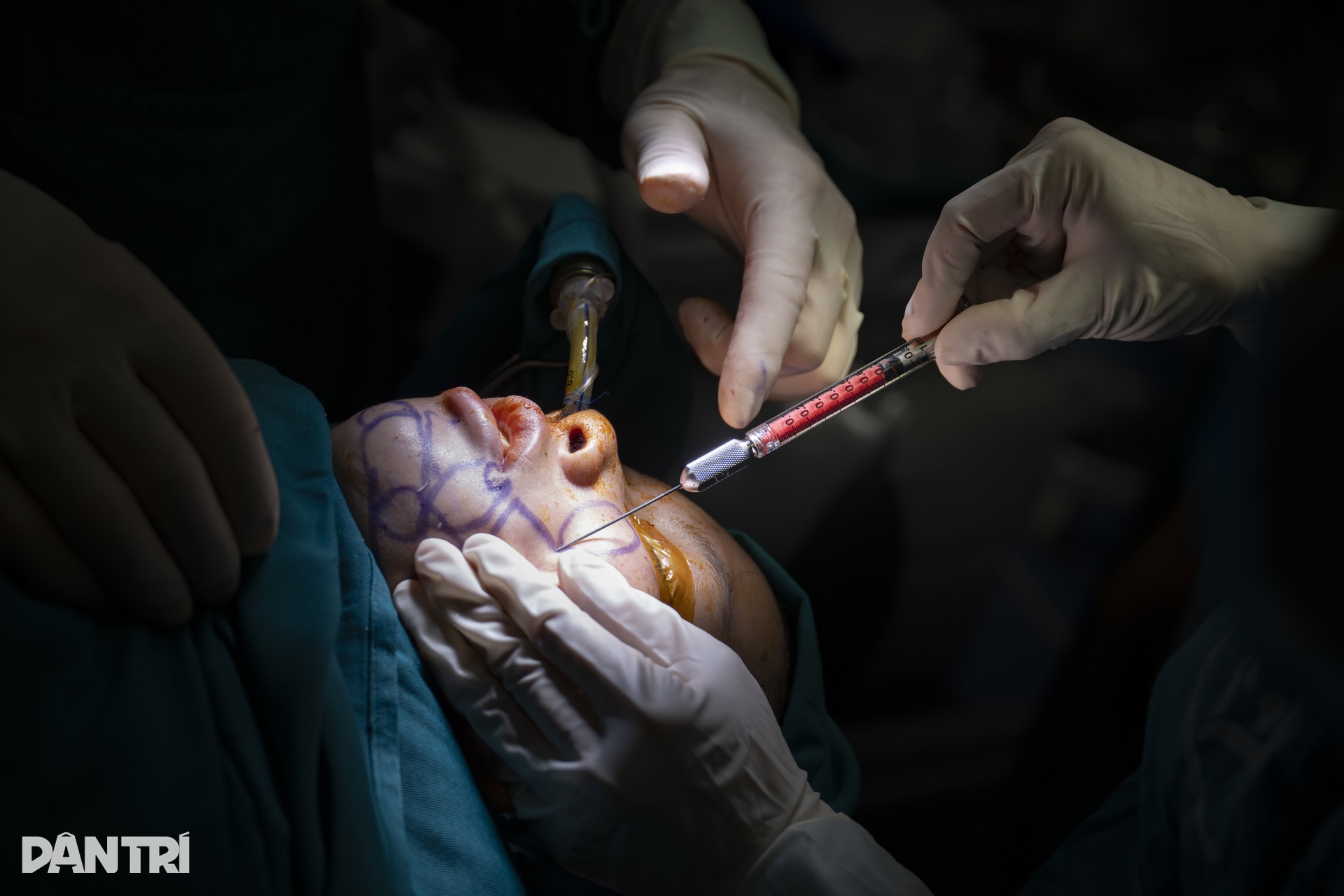 Ca mổ đặc biệt: Bác sĩ Việt - Mỹ cùng tạc lại gương mặt vẹn tròn cho em thơ - 18