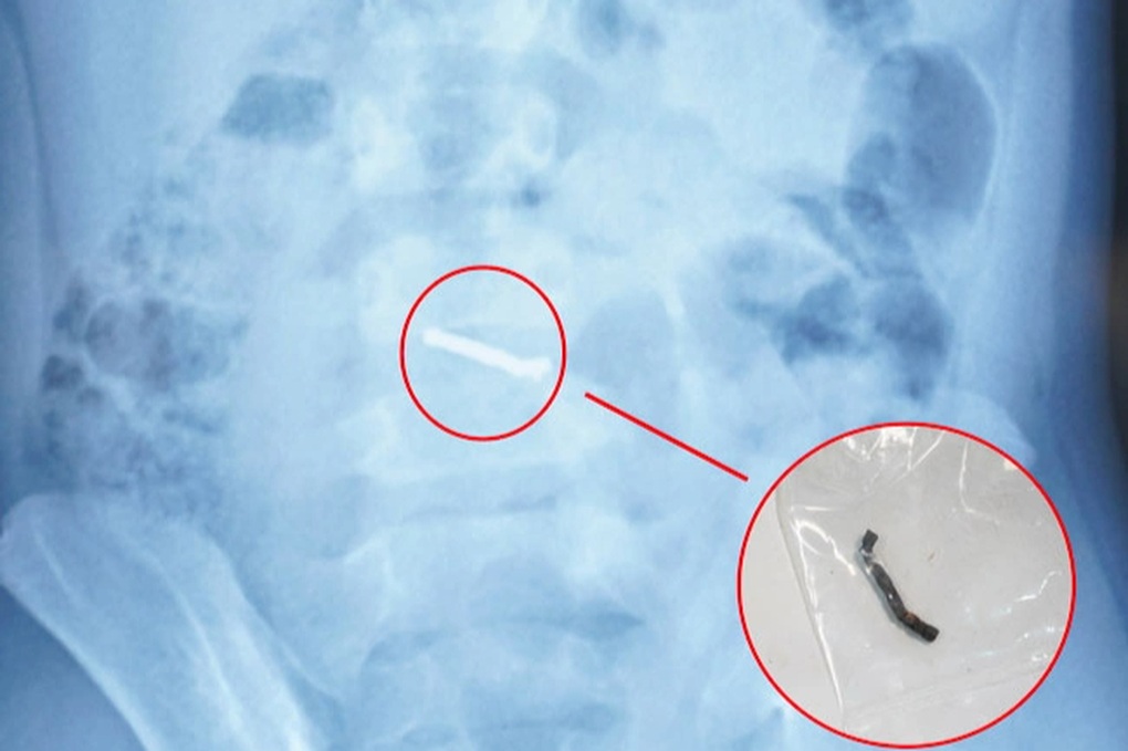 Dị vật nam châm xếp hàng dài, gây thủng ruột bé trai 5 tuổi - 2