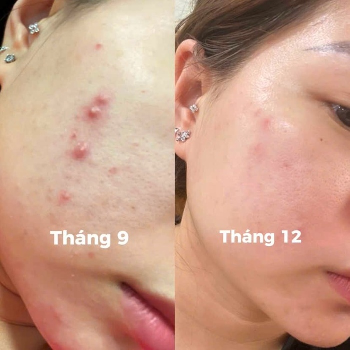 Trải nghiệm 4 tuần dùng Tinh chất kẽm hỗ trợ giảm mụn và kiểm soát dầu Actidem ZNP Serum trên da dầu mụn