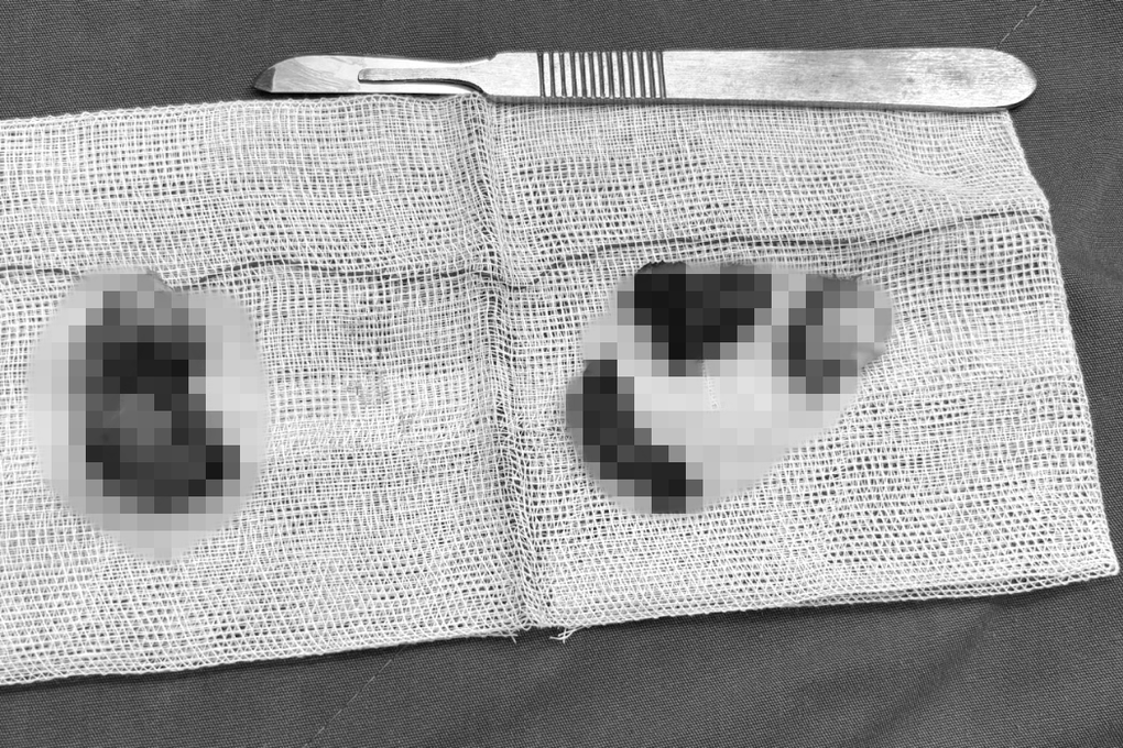 Đau tinh hoàn cả năm, người đàn ông bất ngờ khi mắc bệnh hiếm - 2