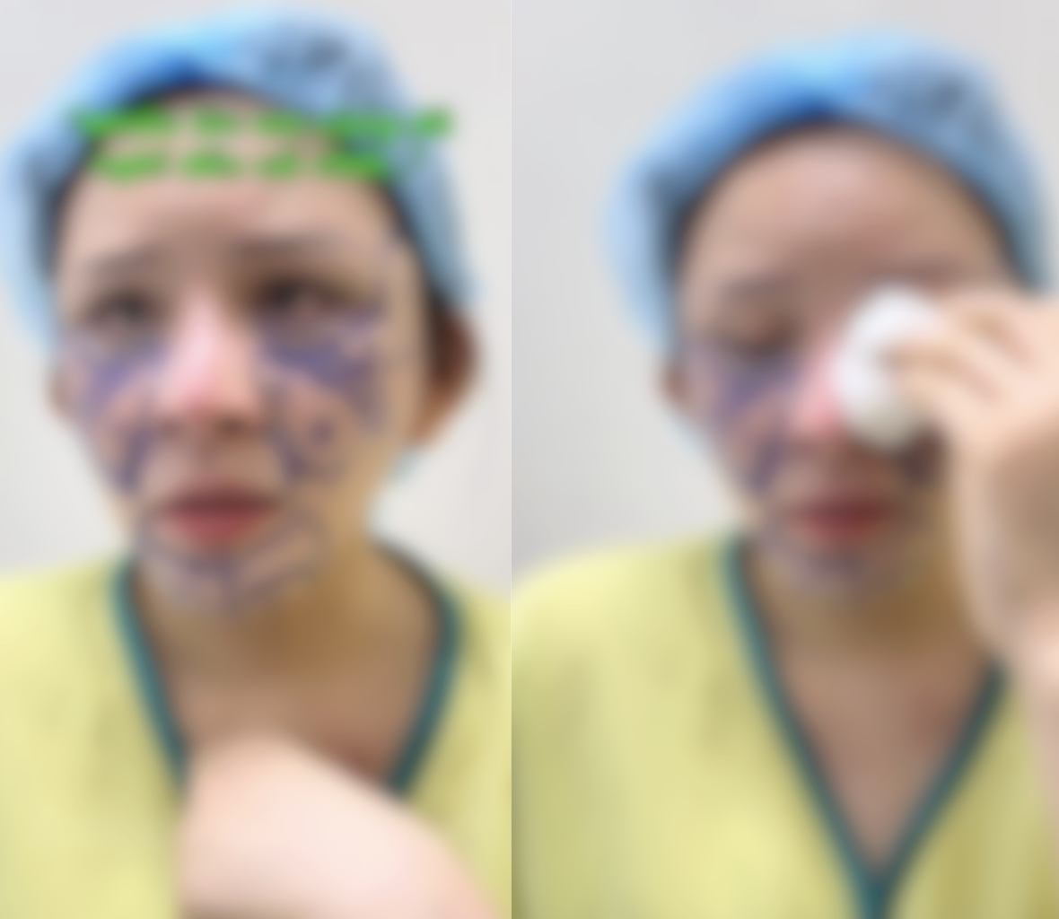 Xôn xao vụ cô gái hút mỡ hết 70 triệu nhận lại mặt biến dạng, nửa đêm 