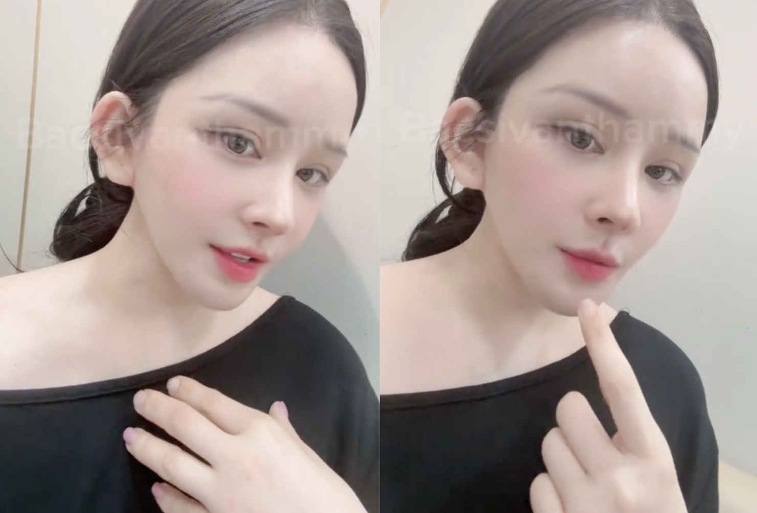 Xôn xao vụ cô gái hút mỡ hết 70 triệu nhận lại mặt biến dạng, nửa đêm 