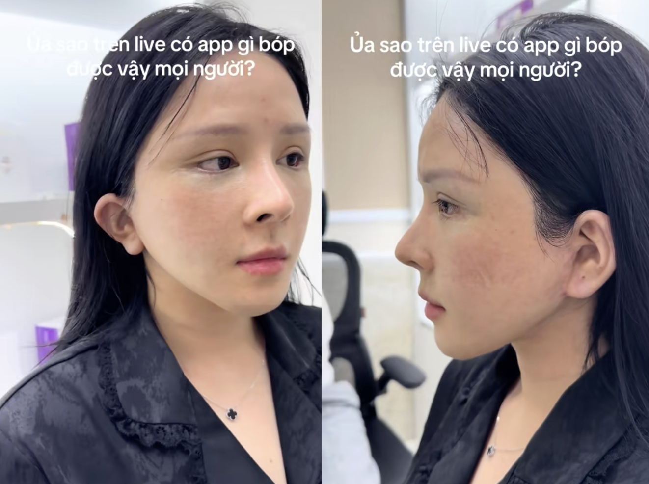 Xôn xao vụ cô gái hút mỡ hết 70 triệu nhận lại mặt biến dạng, nửa đêm 