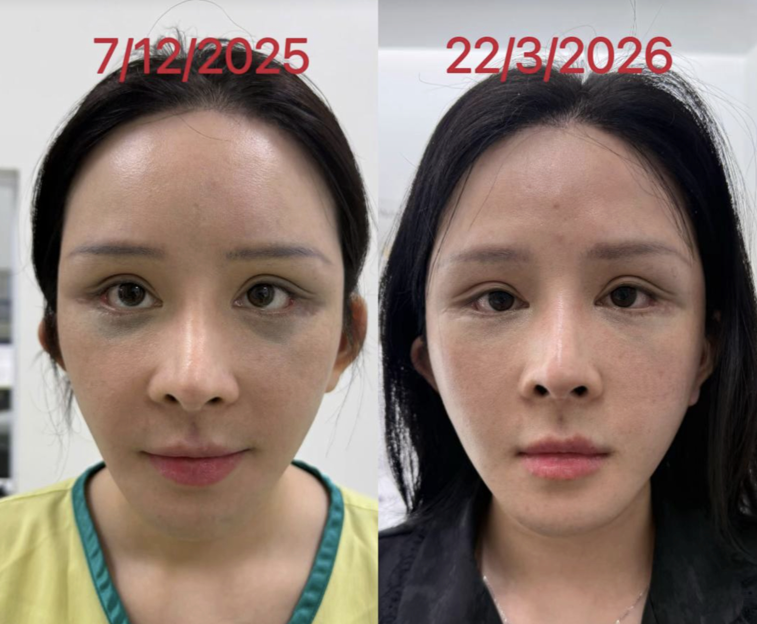 Xôn xao vụ cô gái hút mỡ hết 70 triệu nhận lại mặt biến dạng, nửa đêm 