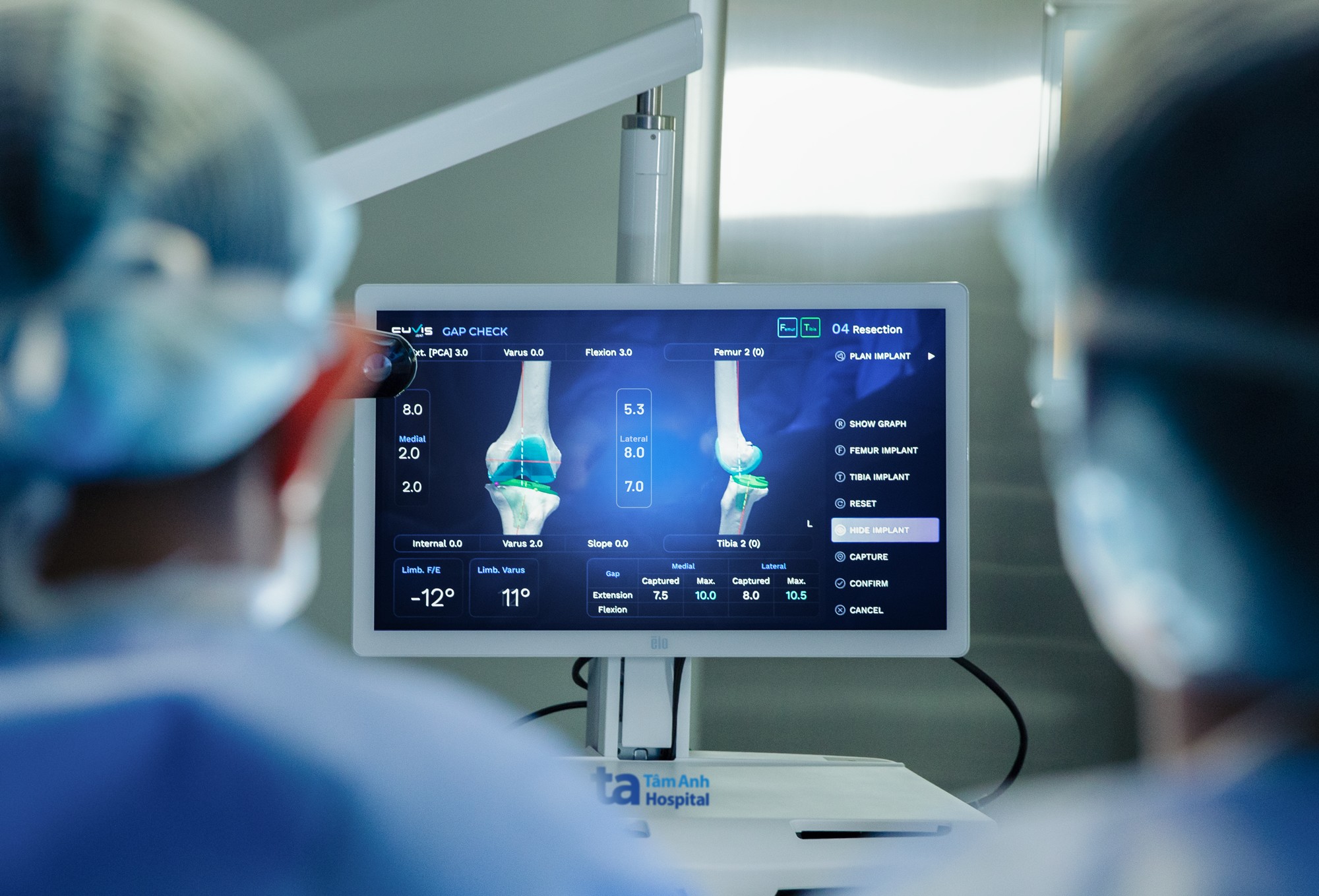 Phần mềm tích hợp AI chuyên dụng của Robot CUVIS-Joint giúp bác sĩ lập kế hoạch mổ “siêu nhanh” và dễ dàng tinh chỉnh kế hoạch, đảm bảo độ chuẩn xác vượt trội khi mổ thực tế.