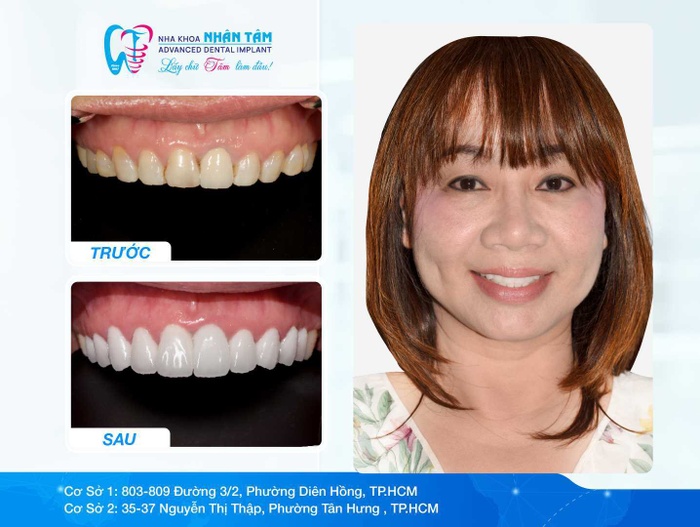 Những màn "lột xác" nụ cười từ triết lý Xâm lấn tối thiểu – Độ bền tối đa tại Nha khoa Nhân Tâm 3 Showcase: Những màn lột xác nụ cười từ triết lý Xâm lấn tối thiểu – Độ bền tối đa tại Nha khoa Nhân Tâm