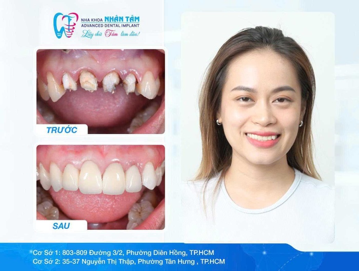 Những màn "lột xác" nụ cười từ triết lý Xâm lấn tối thiểu – Độ bền tối đa tại Nha khoa Nhân Tâm 4 Showcase: Những màn lột xác nụ cười từ triết lý Xâm lấn tối thiểu – Độ bền tối đa tại Nha khoa Nhân Tâm