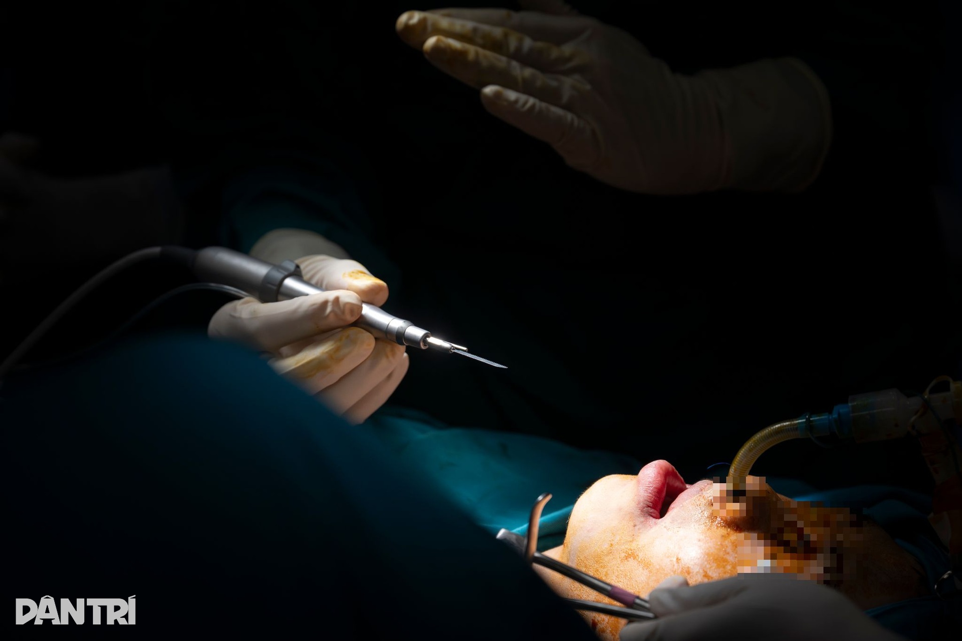 Hồi hộp xem đôi tay bác sĩ Việt - Mỹ tái tạo gương mặt cậu bé dị tật - 12