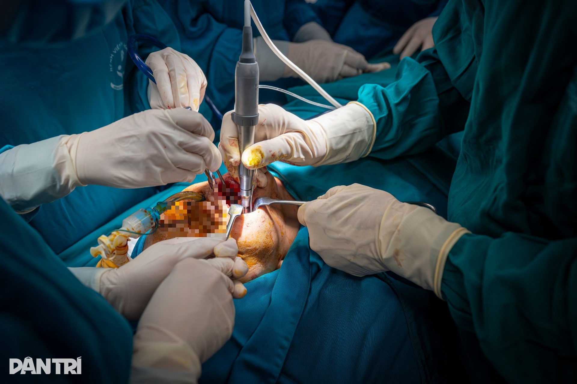 Hồi hộp xem đôi tay bác sĩ Việt - Mỹ tái tạo gương mặt cậu bé dị tật - 13