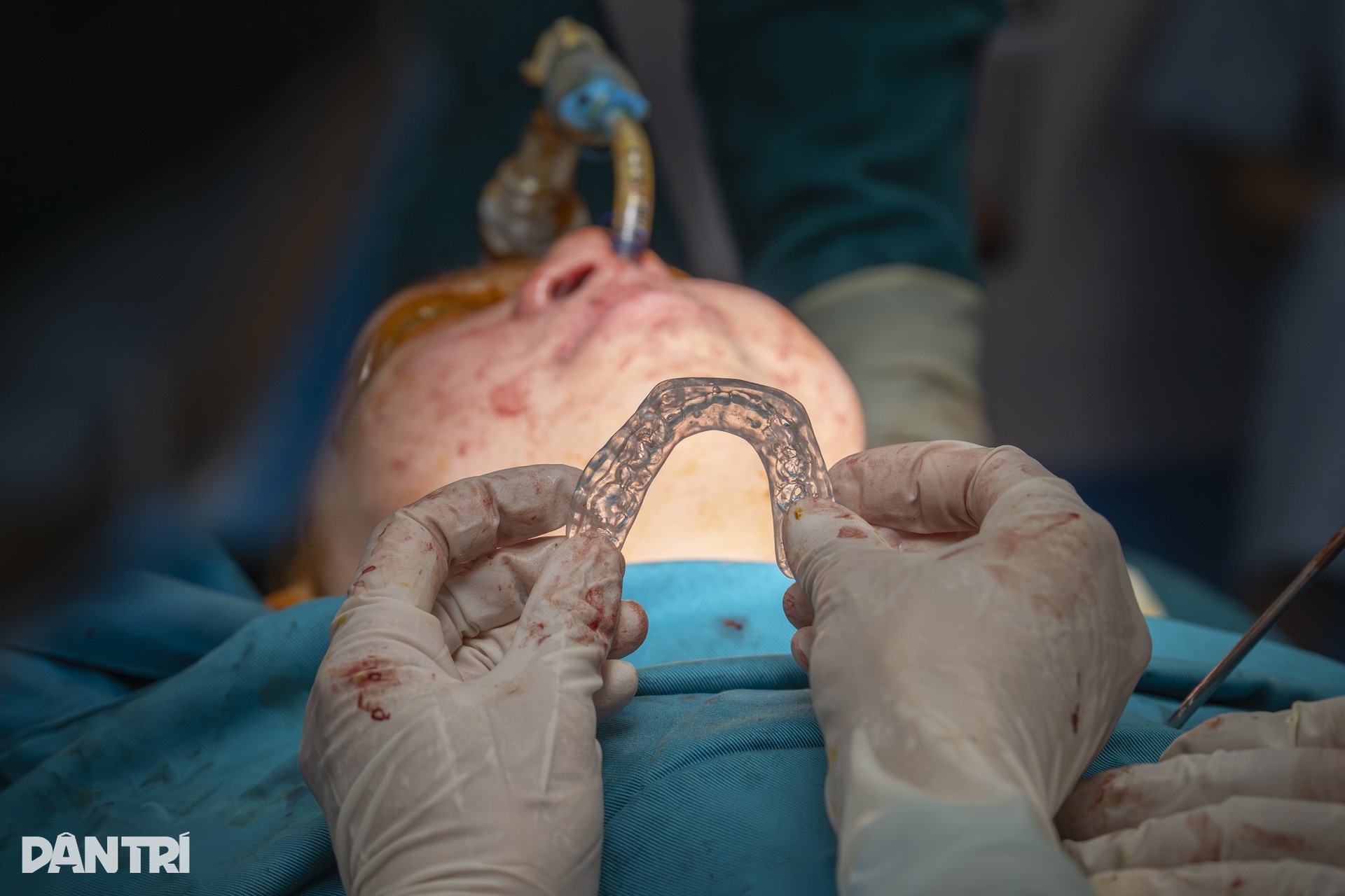 Hồi hộp xem đôi tay bác sĩ Việt - Mỹ tái tạo gương mặt cậu bé dị tật - 18