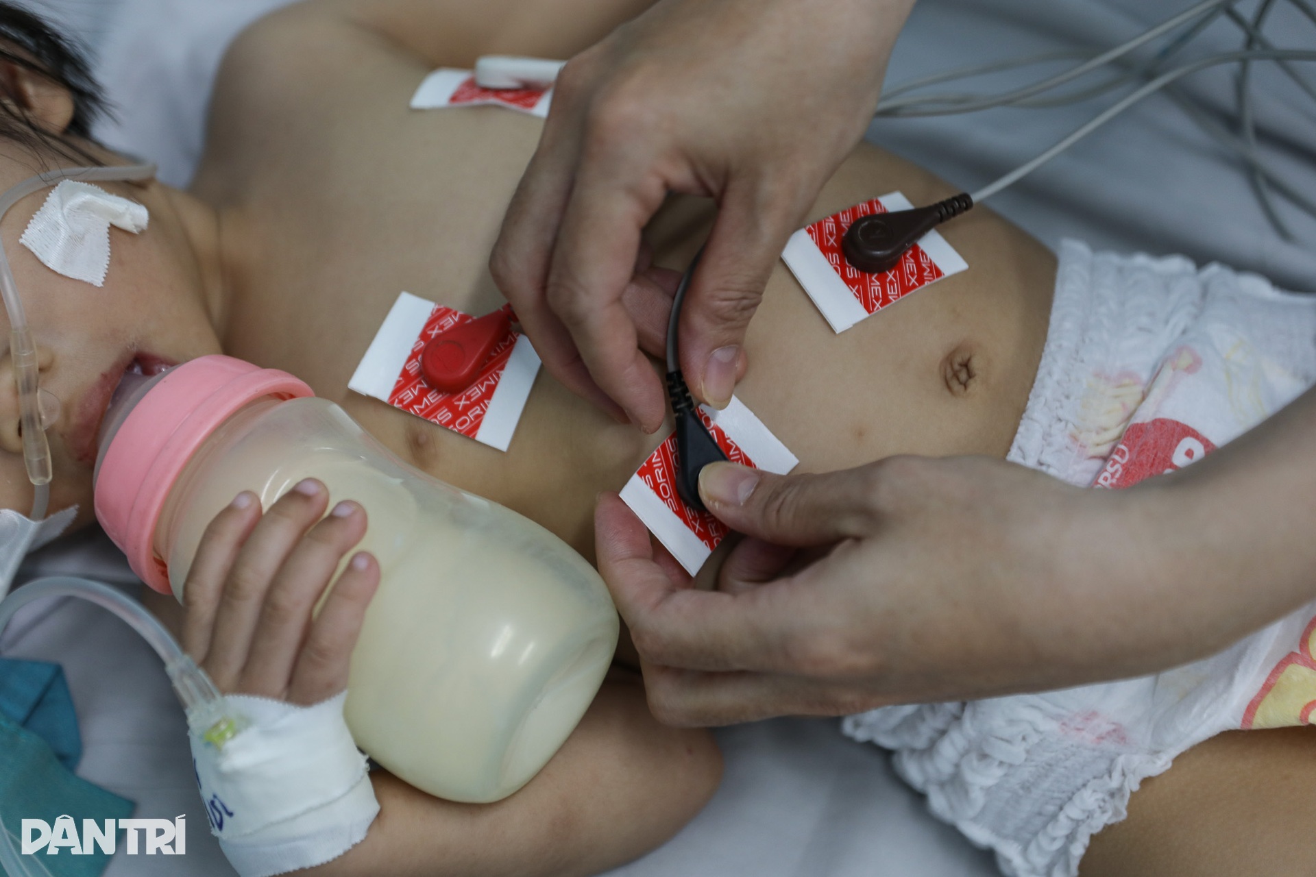 Bên trong nơi cứu chữa trẻ mắc tay chân miệng nặng, biến chứng ngưng thở - 8