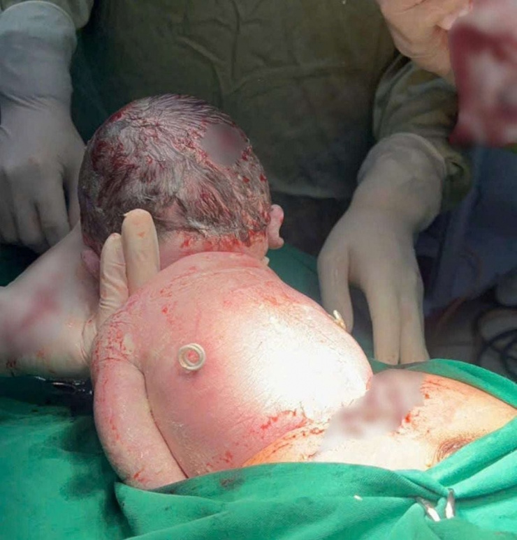 Khoảnh khắc chào đời đặc biệt: Em bé sinh ra với đôi cánh nhỏ trên lưng 3 Em bé cất tiếng khóc đầu đời trong niềm vỡ òa của gia đình và các y, bác sĩ. Nhưng điều khiến nhiều người xúc động hơn cả là hình ảnh phía sau lưng em: hai ống shunt nhỏ vẫn còn nguyên vị trí – như một “đôi cánh tí hon”. Ảnh: BVCC