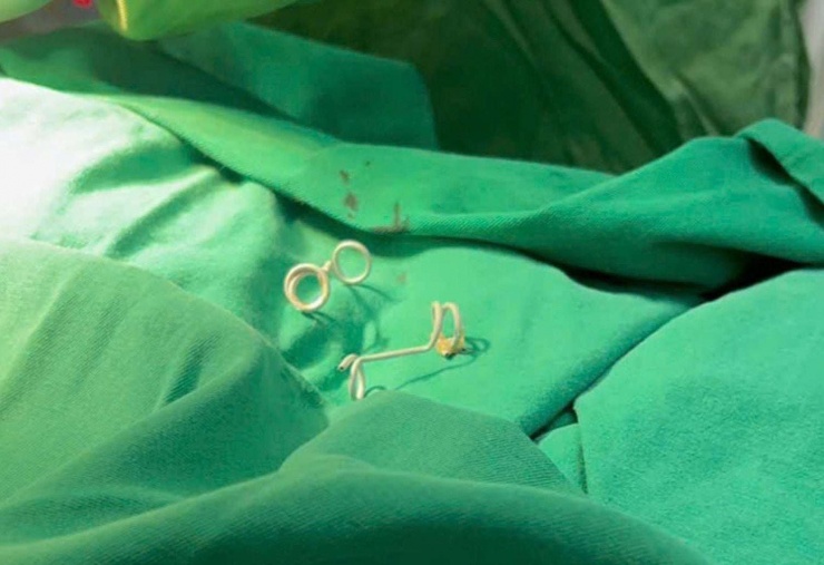 Khoảnh khắc chào đời đặc biệt: Em bé sinh ra với đôi cánh nhỏ trên lưng 4 Ít ai biết rằng, chính “đôi cánh” ấy đã giúp em đi qua giai đoạn mong manh nhất của sự sống, để có thể ở lại trong bụng mẹ thêm từng ngày và chờ đến khoảnh khắc được chào đời. Ảnh: BVCC