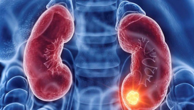 Người đàn ông bất ngờ phát hiện mắc ung thư thận từ dấu hiệu nhiều người Việt bỏ qua 3 Ảnh minh họa.