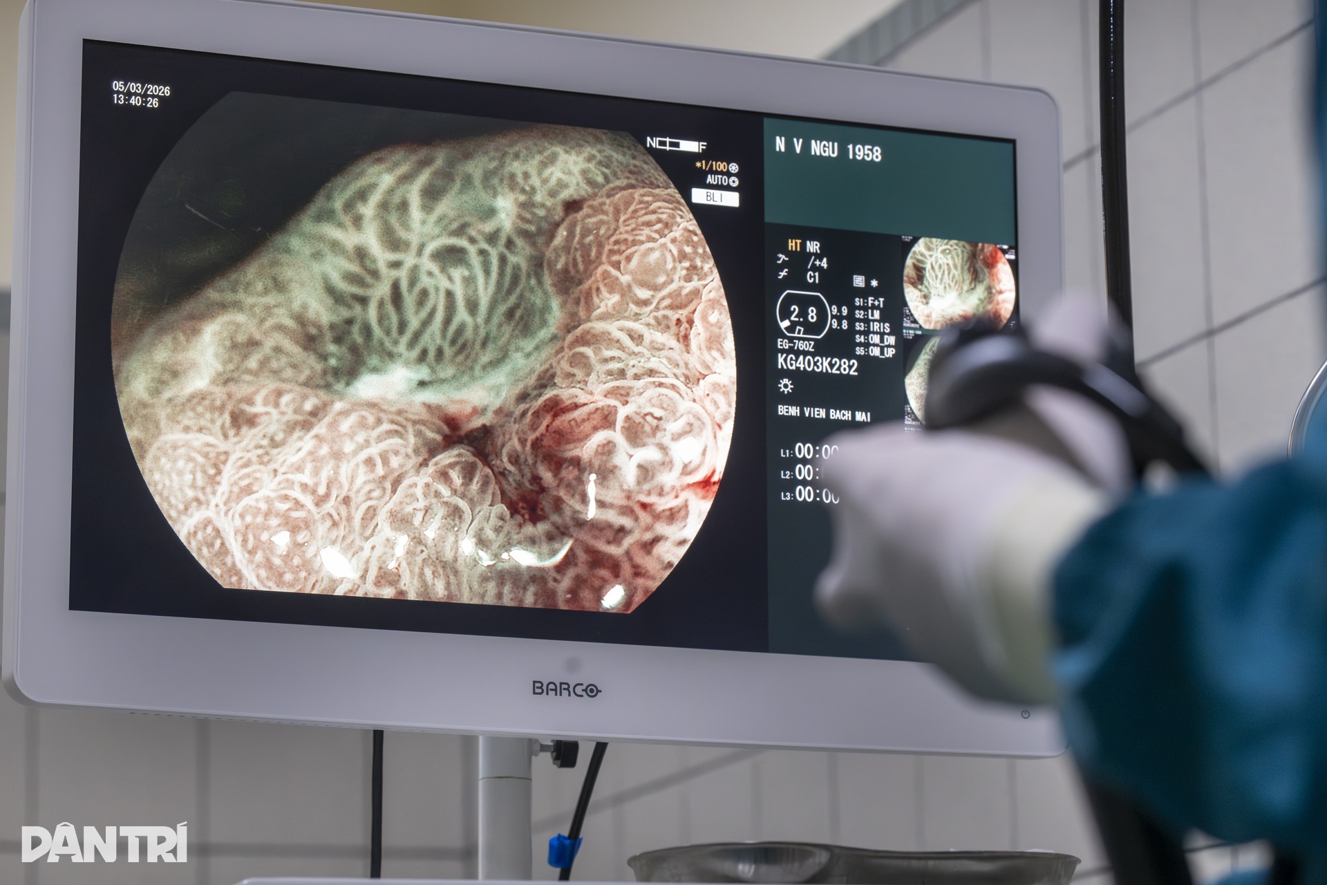 Xem bác sĩ biến ung thư thành bong bóng, loại bỏ hoàn toàn khỏi dạ dày - 10