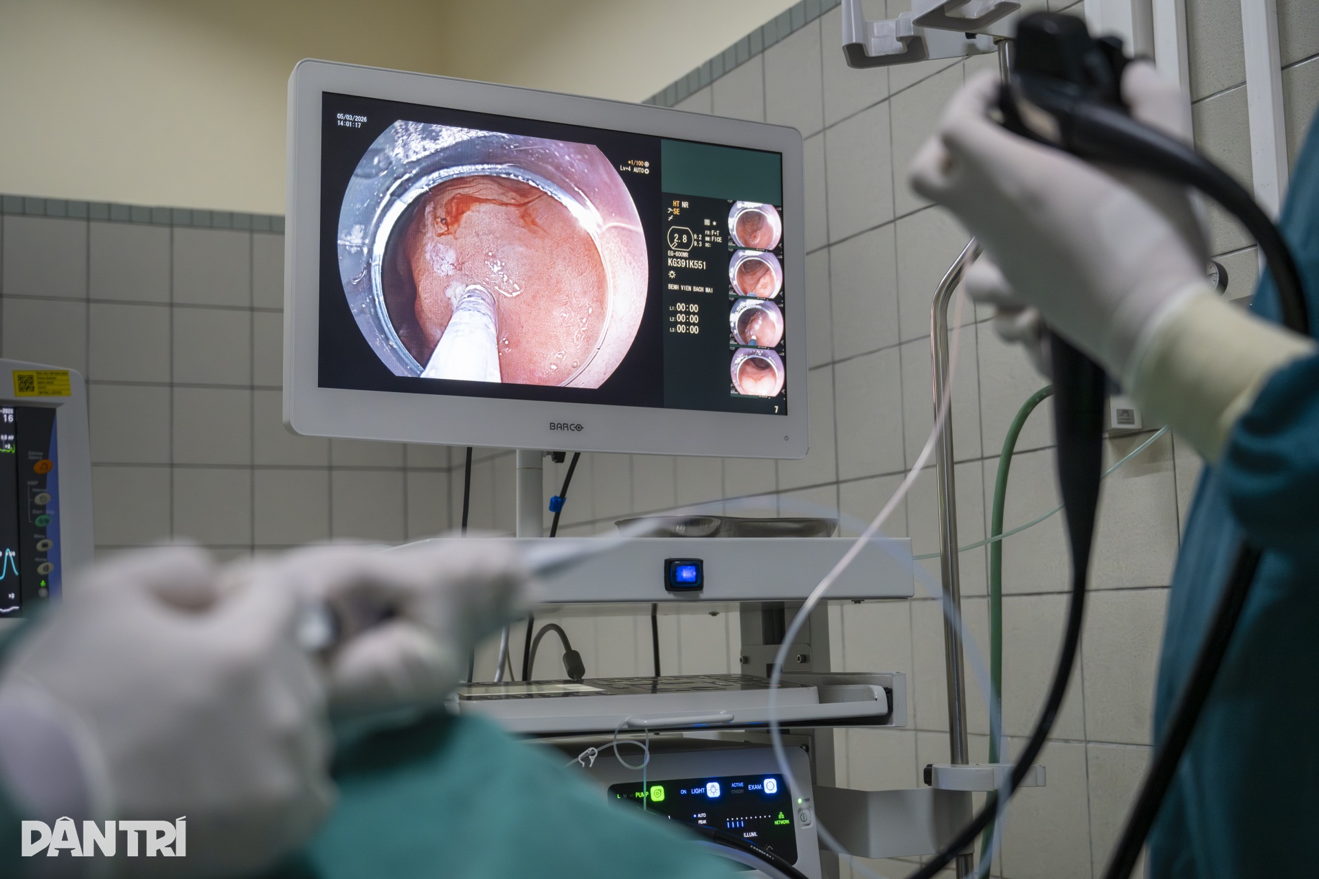 Xem bác sĩ biến ung thư thành bong bóng, loại bỏ hoàn toàn khỏi dạ dày - 13