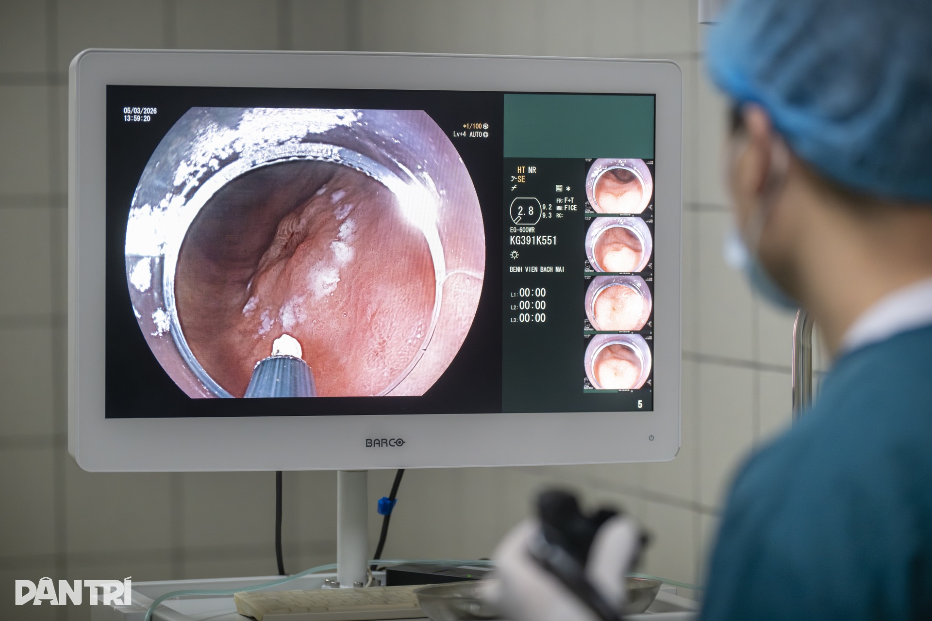 Xem bác sĩ biến ung thư thành bong bóng, loại bỏ hoàn toàn khỏi dạ dày - 14